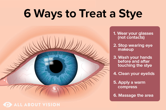 Stye Treatment: How To Get Rid of a Stye