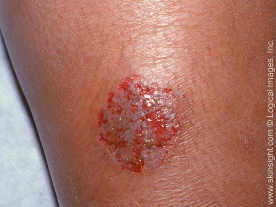 Nummular Dermatitis Condition, Treatments and Pictures for Teens - Skinsight